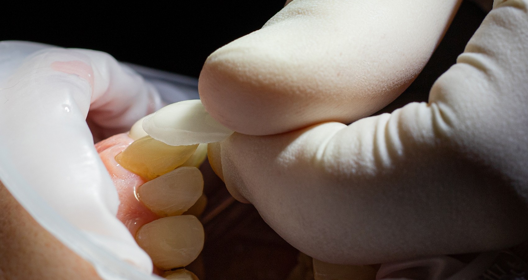 facetas dentárias no Porto